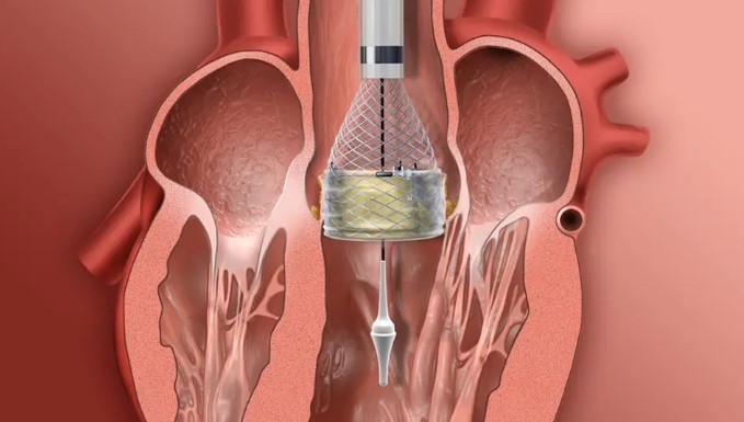 Memorial Medical Center the Only Hospital In Southern New Mexico Performing TAVR Procedure For Heart Valve Disease